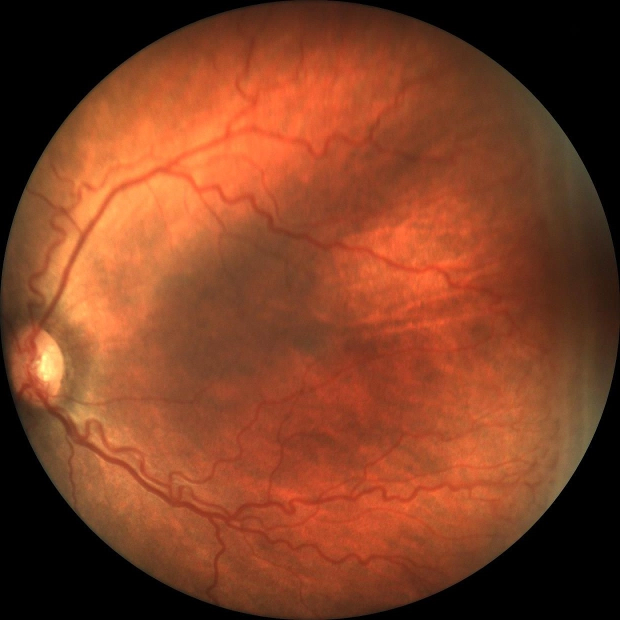 Retina Treatment