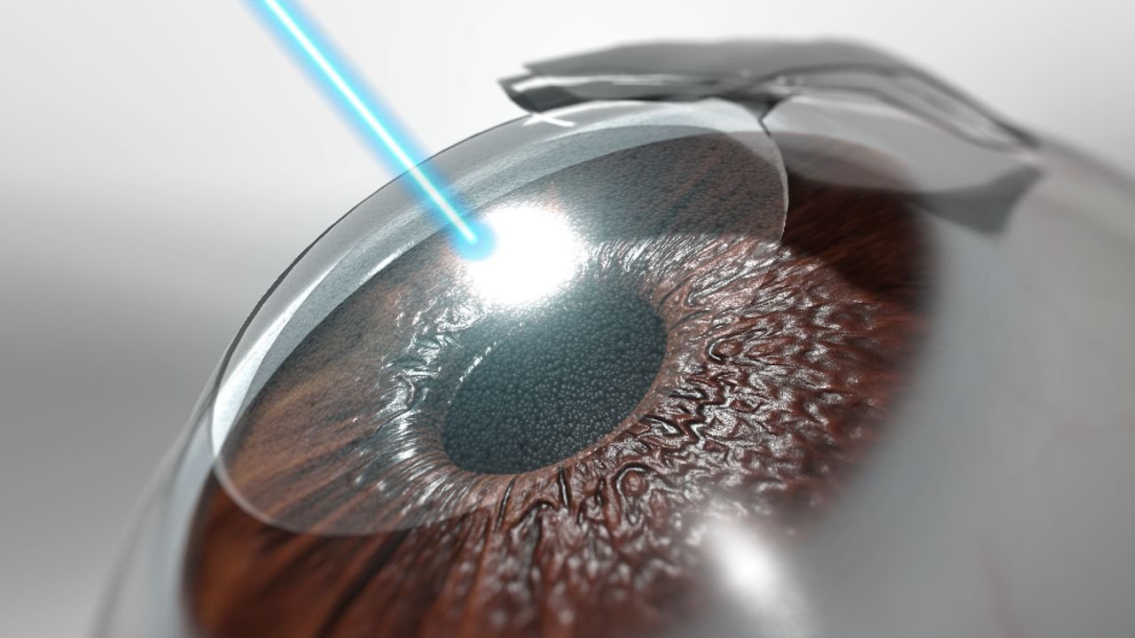Lasik Surgery
