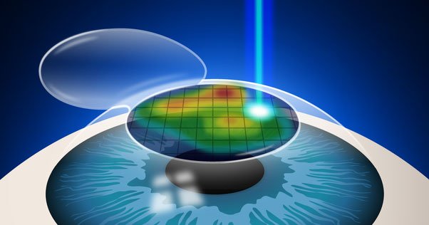 Contoura Vision (Advanced Laser Eye Surgery)