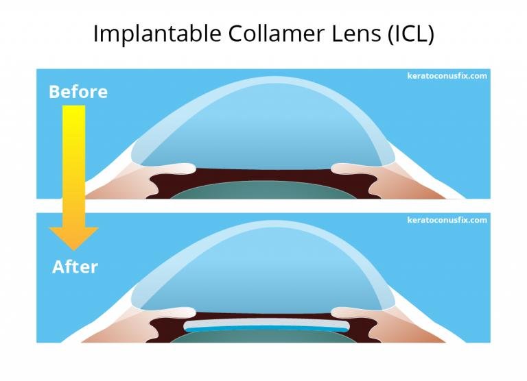 ICL-specs-removal