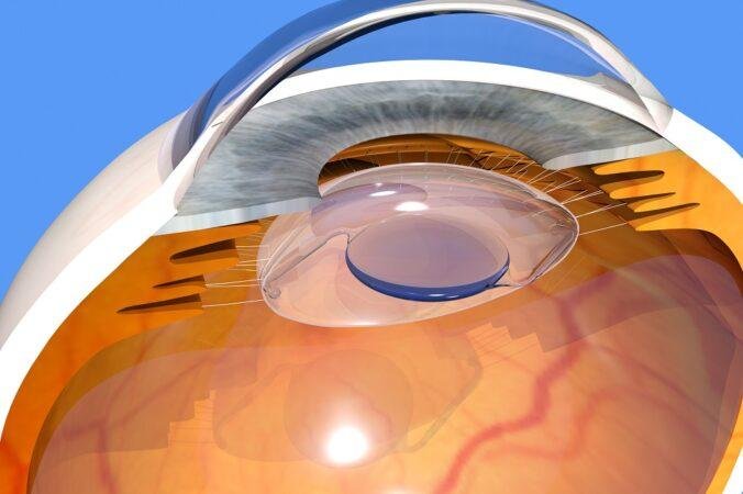 Refractive-Lens-Exchange