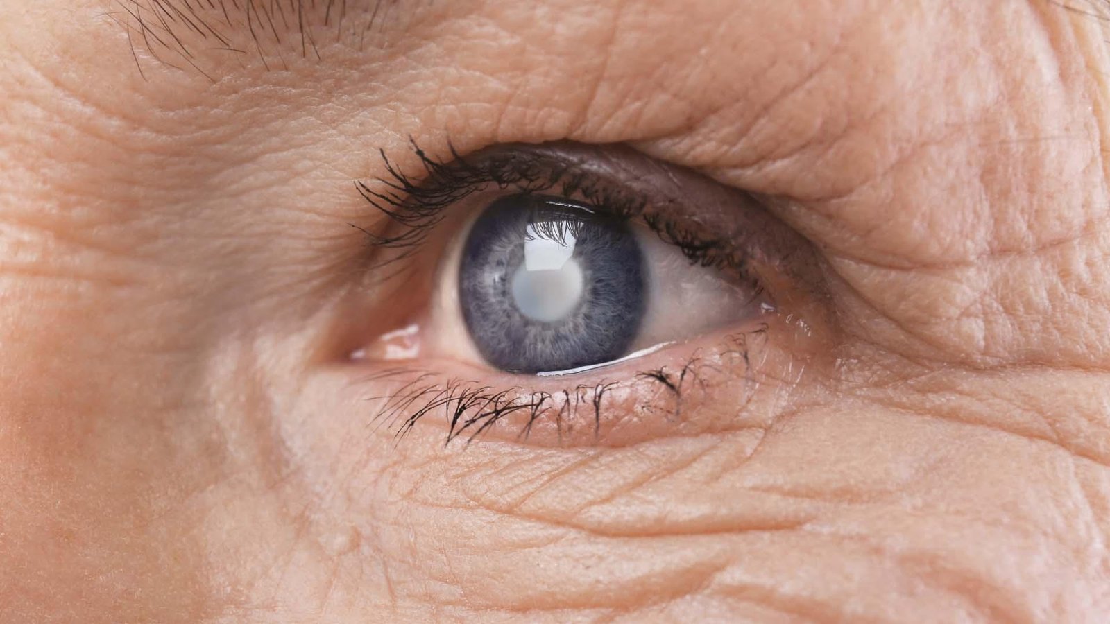 cataract-surgery
