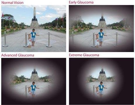 Glaucoma