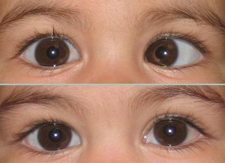 Squint surgery