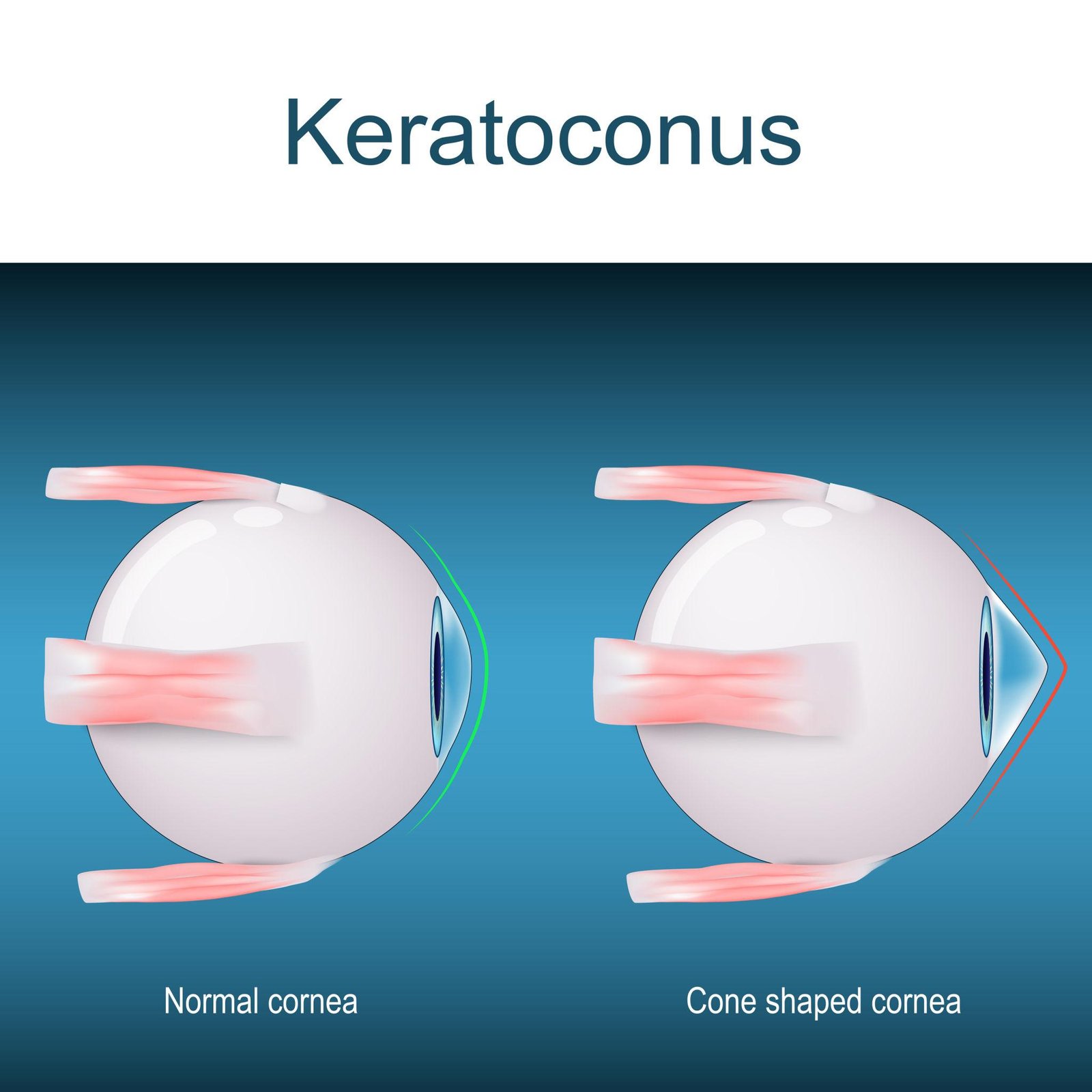 Cornea-and-Keratoconus